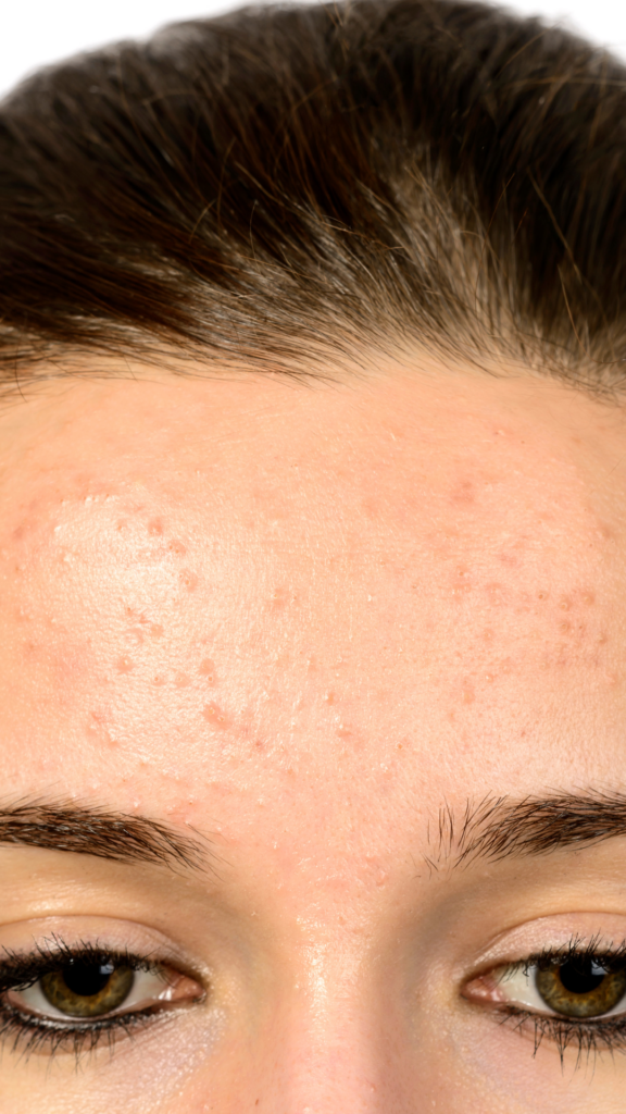 lady's forhead with oil and acne
